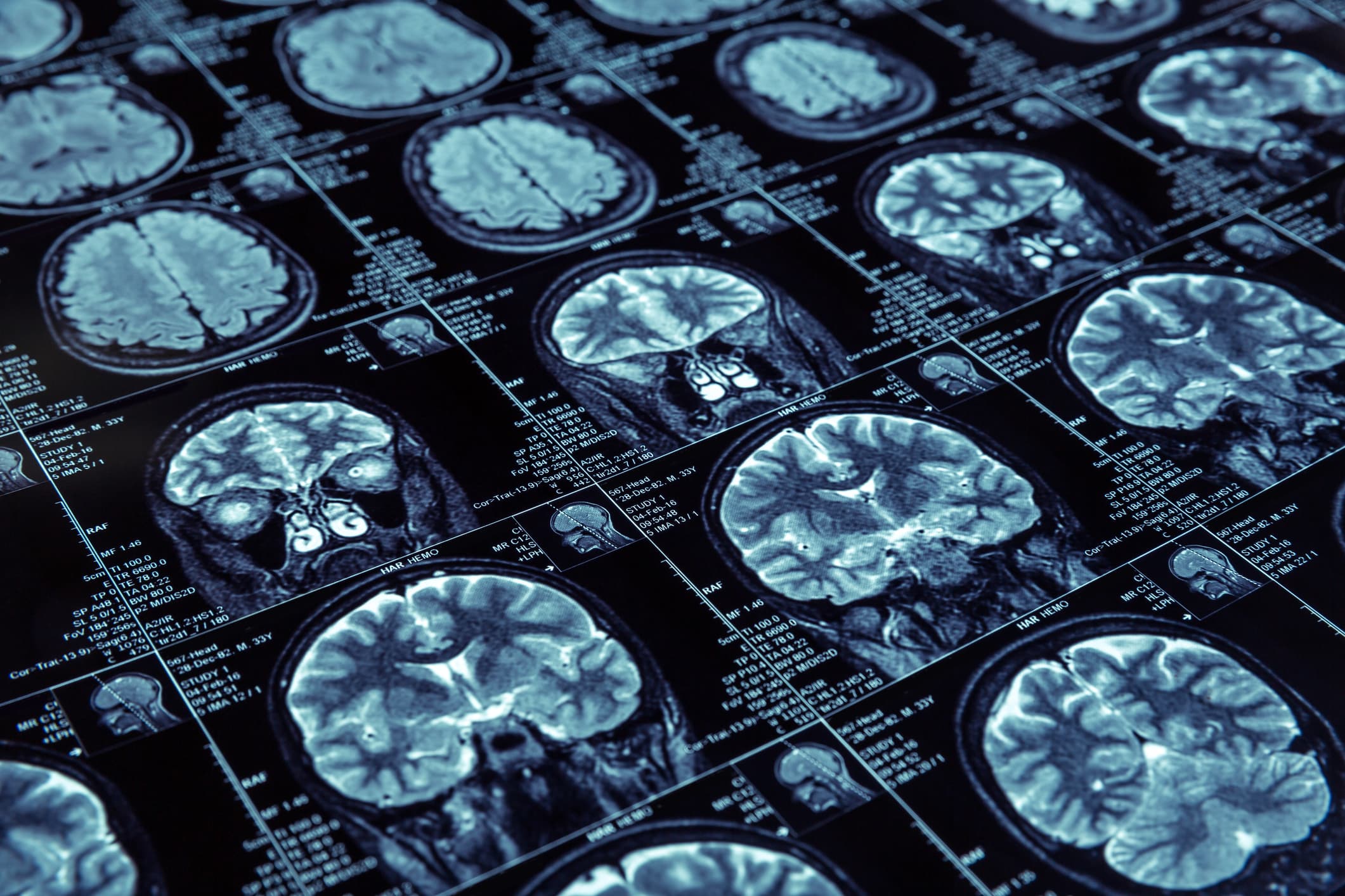 A battle for consumer privacy is emerging as technology devices record our brainwaves.