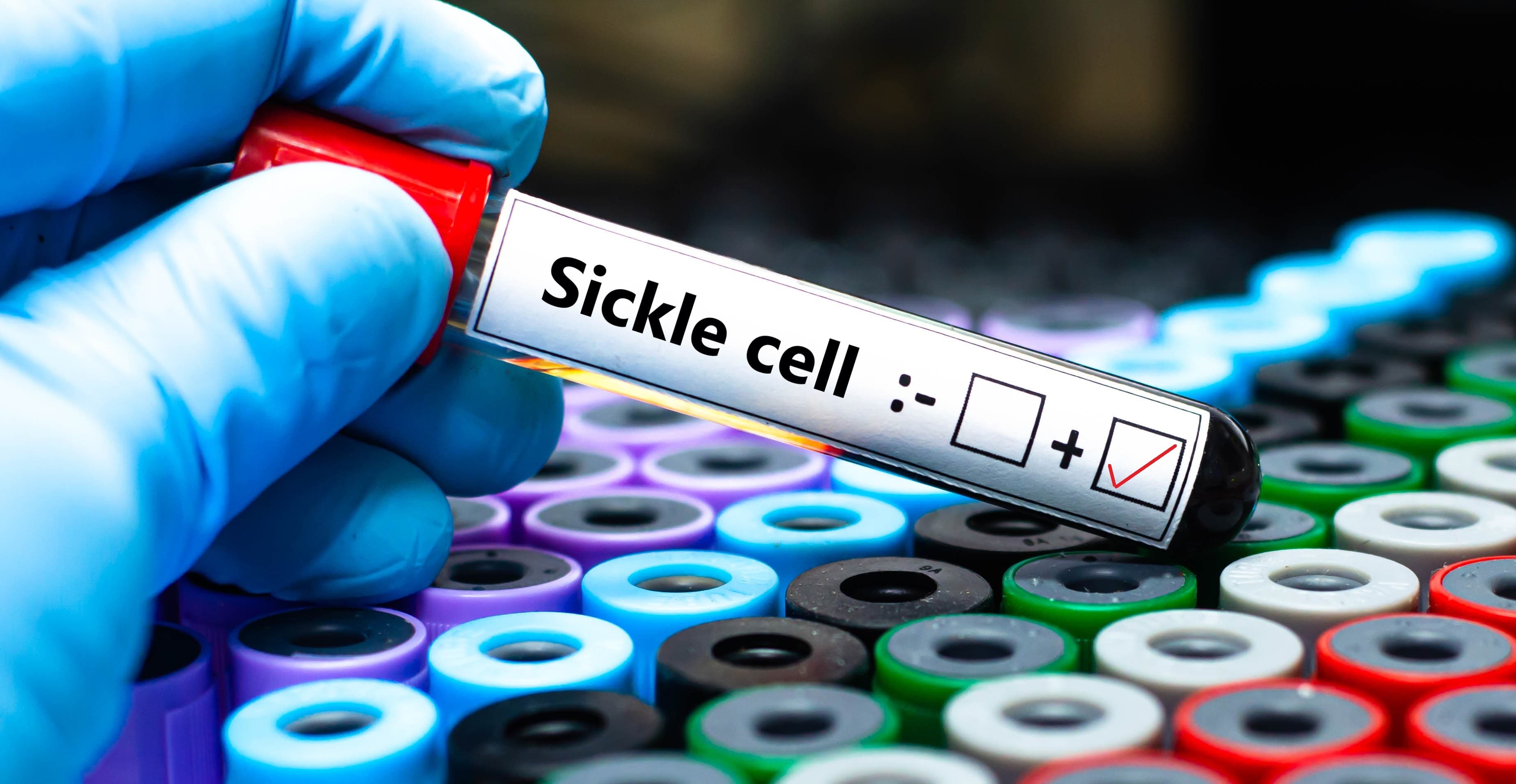 High prices for new sickle cell gene therapies present a challenge despite their breakthrough potential.