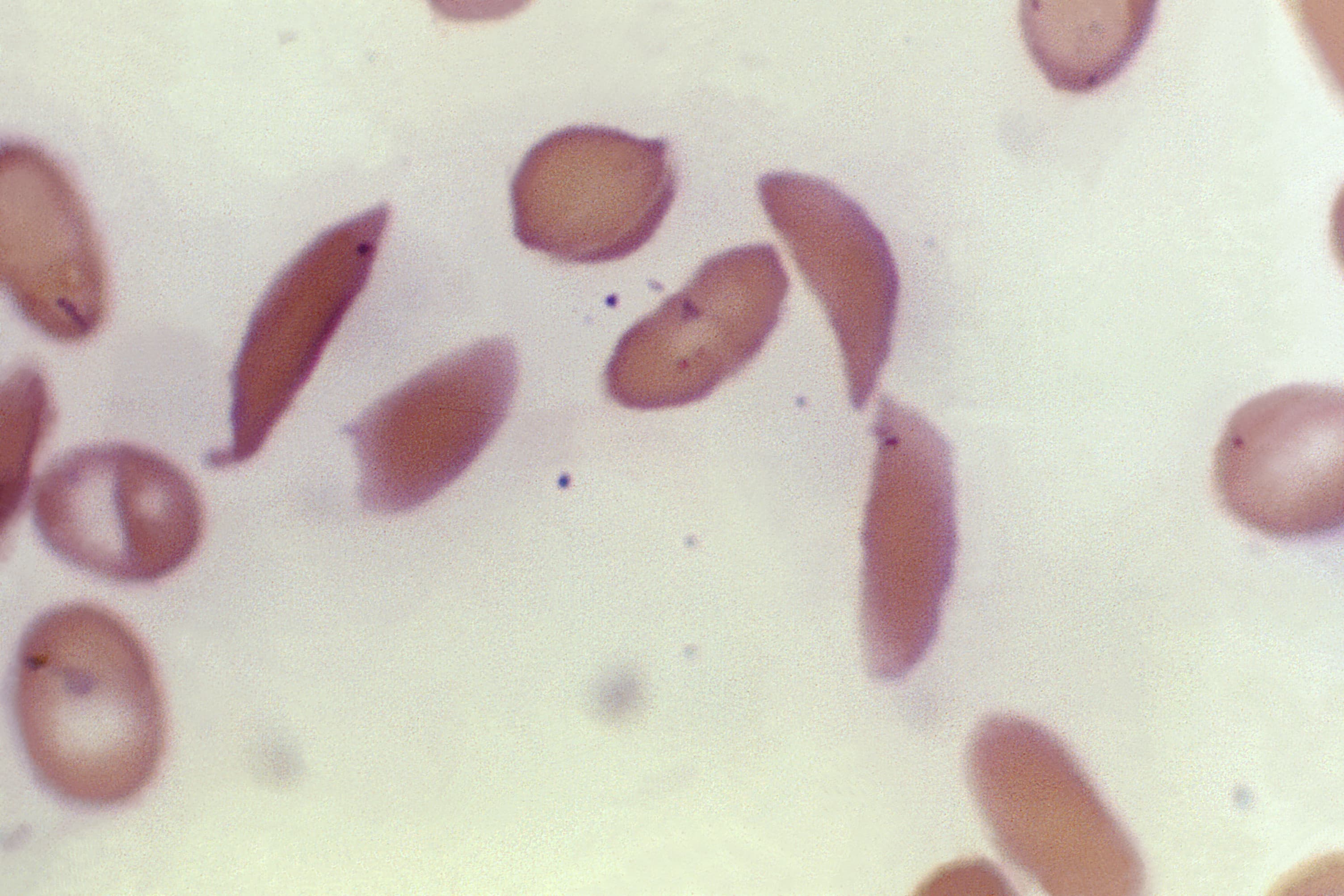 The U.S. greenlights the first gene-editing therapy, Casgevy, for the treatment of sickle cell disease.
