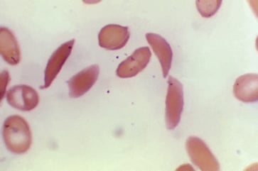 The U.S. greenlights the first gene-editing therapy, Casgevy, for the treatment of sickle cell disease.